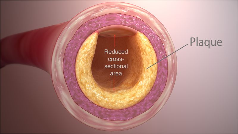 File:Clogged artery.jpg